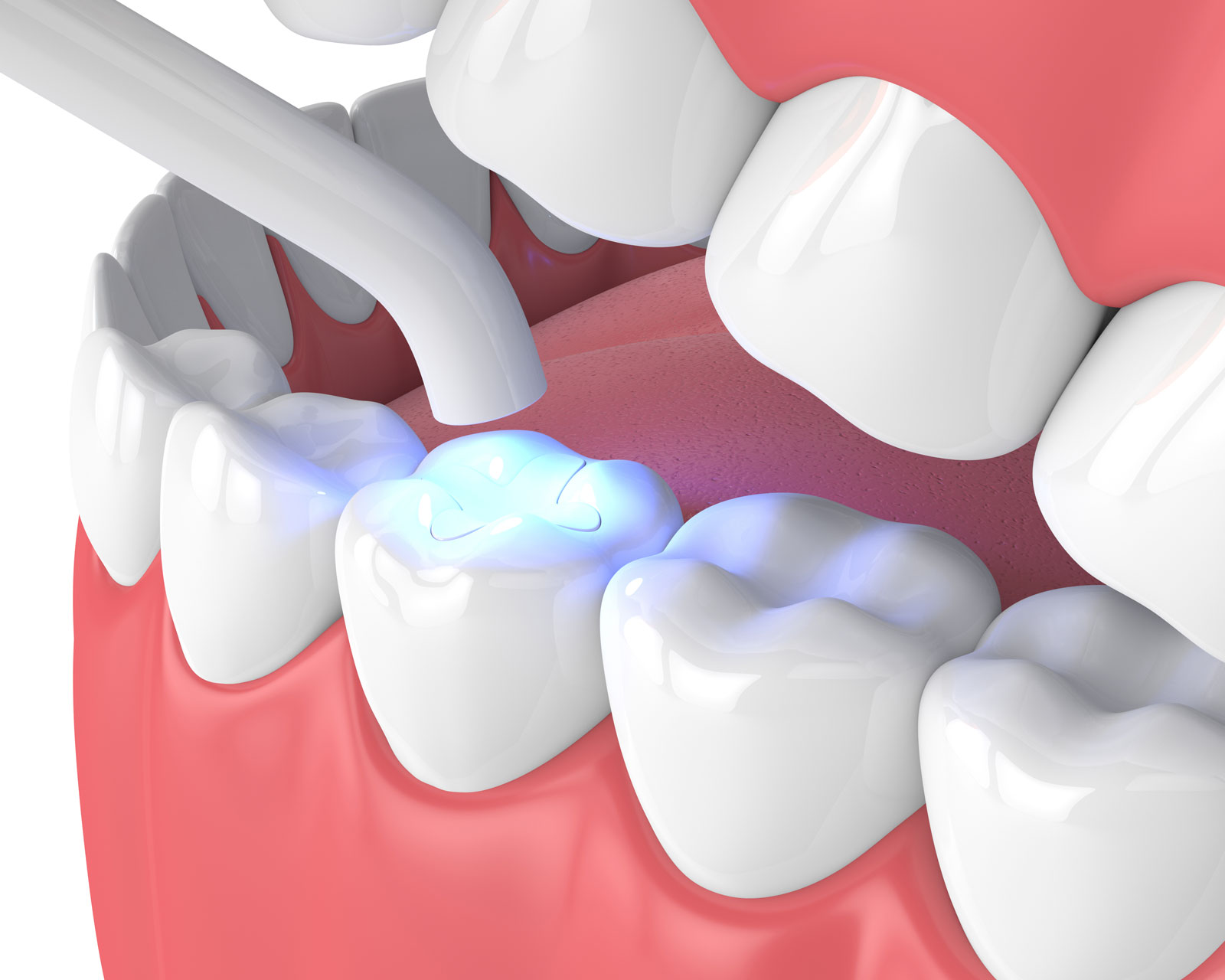 Composite filling