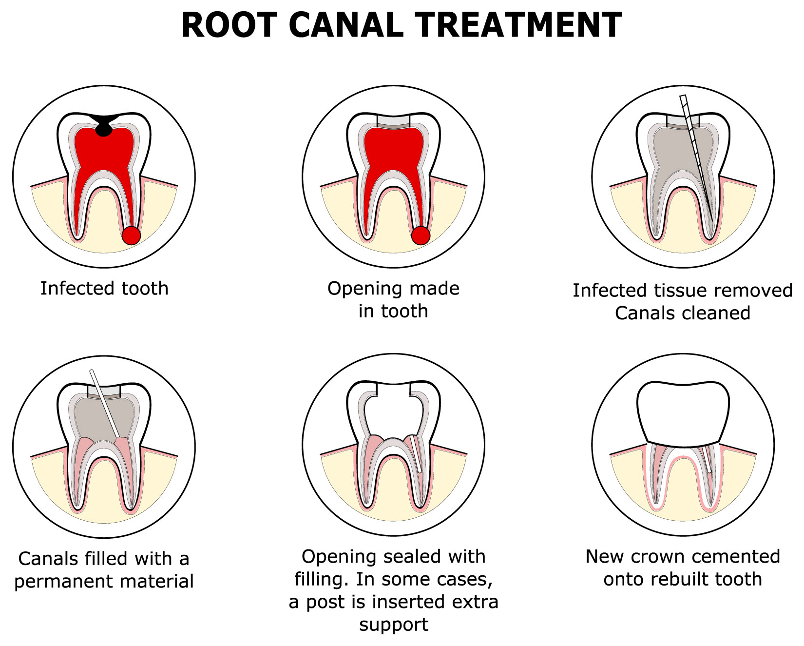 Root canal