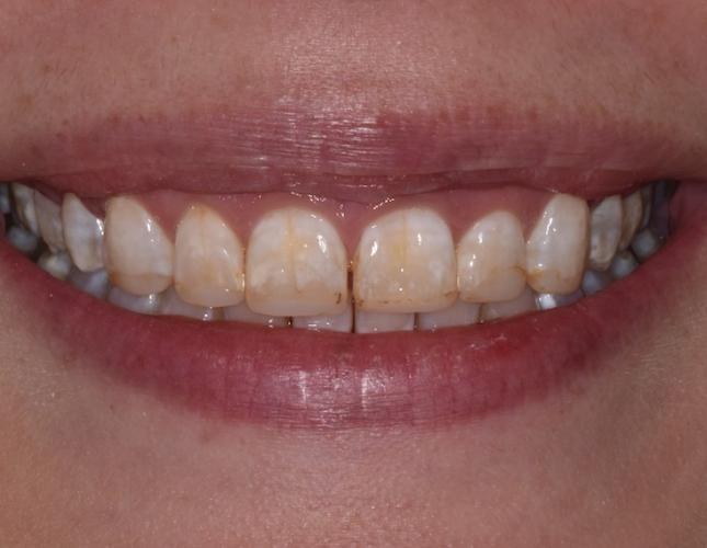 before image