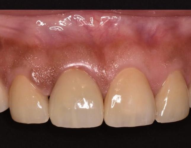 cosmetic_crowns_after-2.jpg