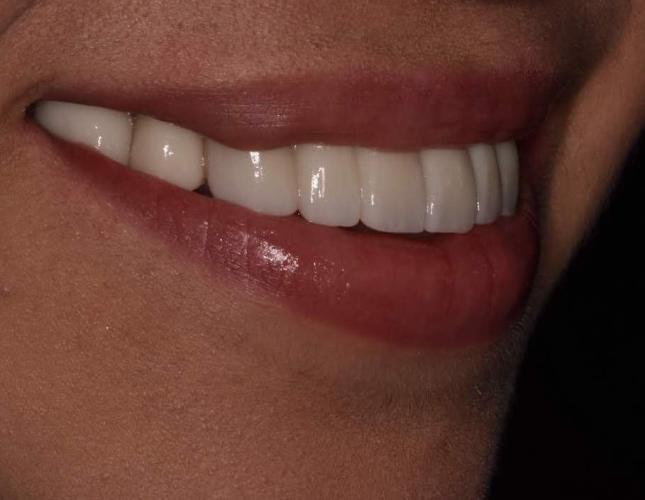 crowns_implants_after-2.jpg