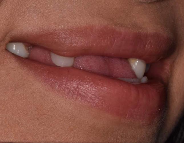 crowns_implants_before-2.jpg