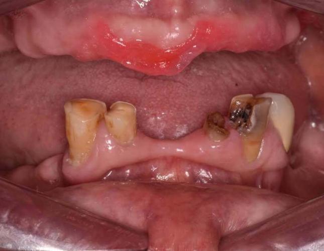 implant_denture_makeover_after-2.jpg