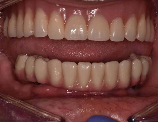 implant_denture_makeover_before-2.jpg