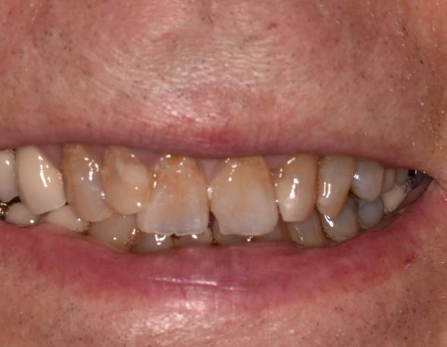 smile_makeover_before