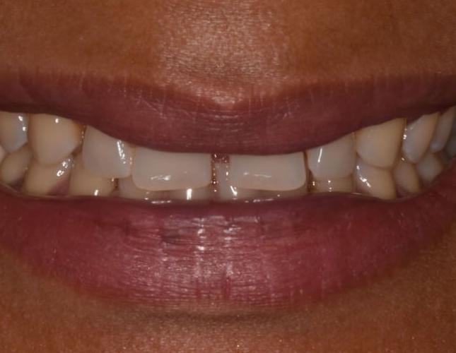 veneer_crowns_2_before-2.jpg