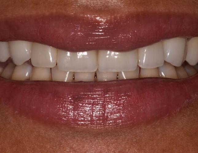 veneer_crowns_ater-2.jpg