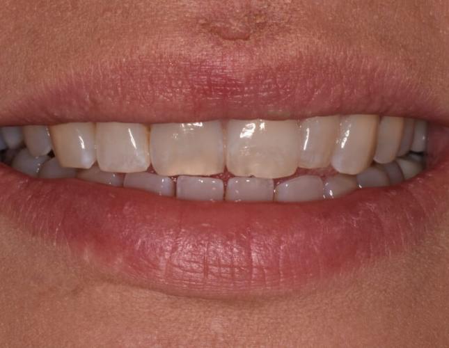veneer_crowns_invisalign_after-2.jpg