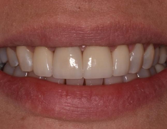 veneer_crowns_invisalign_before-2.jpg