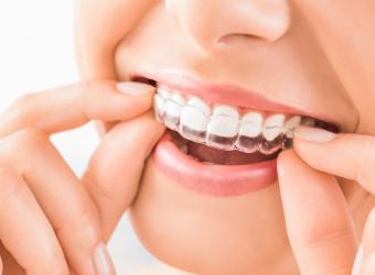 Read this if you're considering online clear aligners or other online dental products!